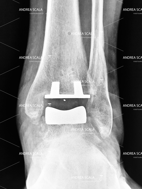 Radiografia-impianto-protesi.