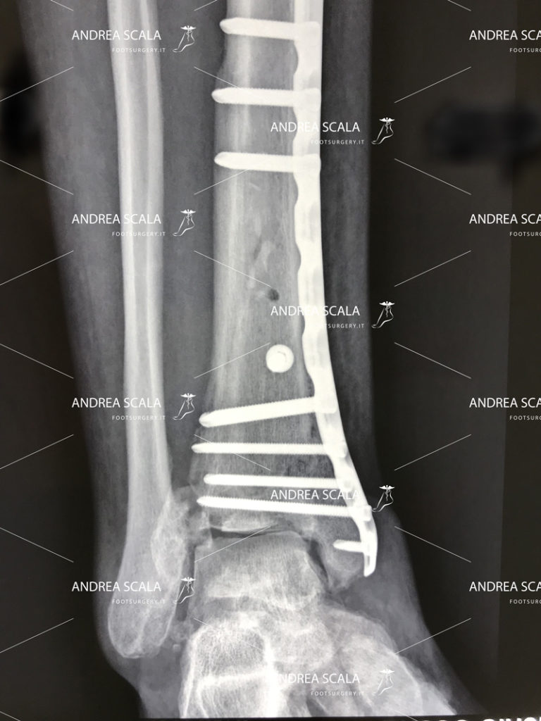 grave-frattura-della-caviglia
