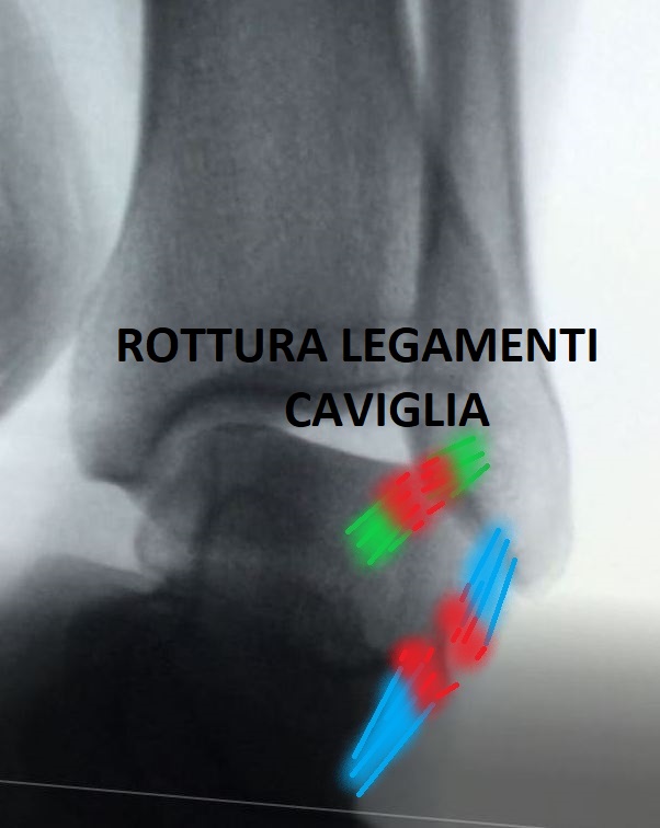 rottura legamenti caviglia quando operare