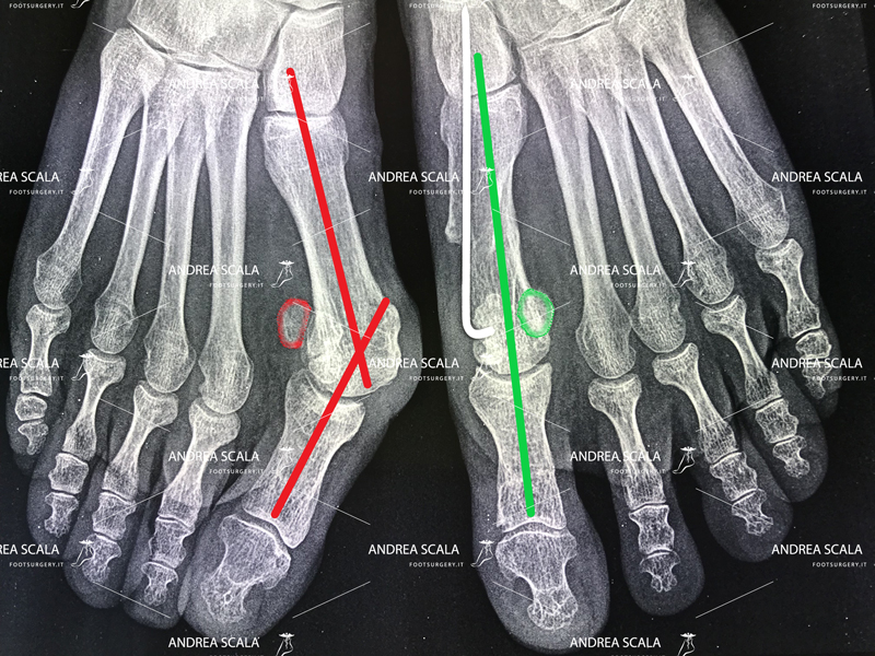 rx-alluce-valgo-pre-intervento