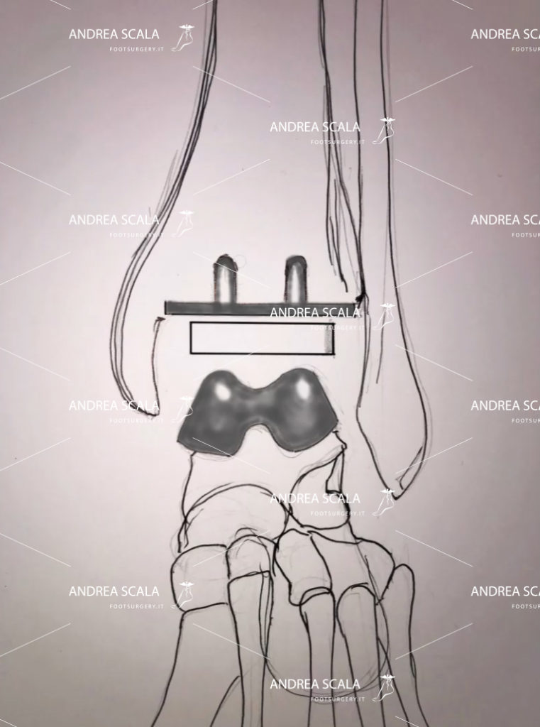 schema-di-protesi-con-menisco-mobile