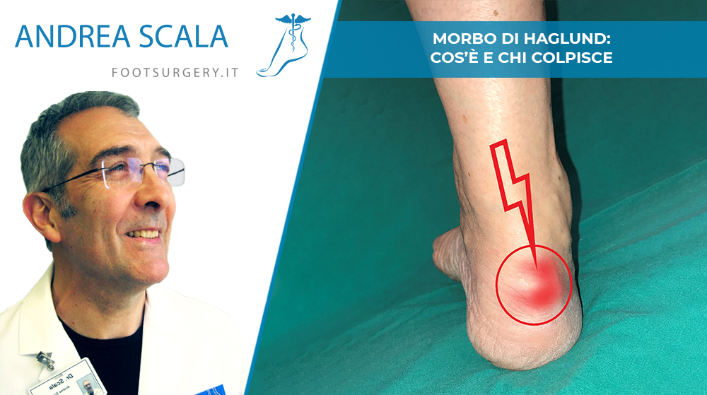 Morbo di Haglund: cos’è e chi colpisce