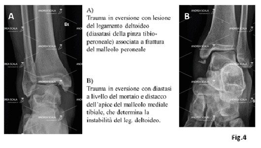 trauma distorsivo caviglia