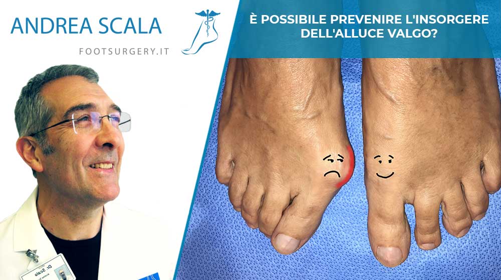 E' possibile prevenire l'insorgere dell'alluce valgo?