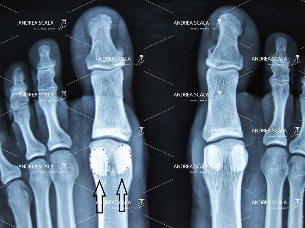 La Rxgrafia mostra la posizione normale dei due sesamoidi sotto la testa del 1° metatarsale. 