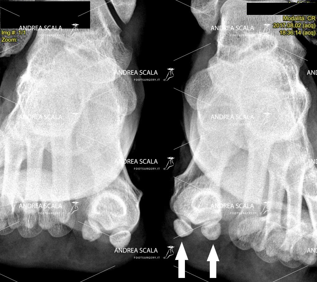 La Rxgrafia mostra la visione della pianta del piede. Si vede ancora meglio la posizione normale dei due sesamoidi sotto la testa del 1° metatarsale. Dopo l’intervento per alluce valgo la testa del 1° metatarsale deve essere stata rimessa al proprio posto sui sesamioidi. Se no l’intervento non è andato bene.