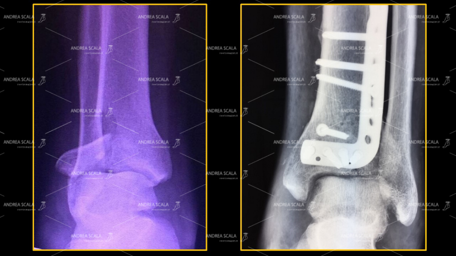 frattura della superficie articolare e della sovrastante metafisi distale di tibia fratture del “pilon tibial”.