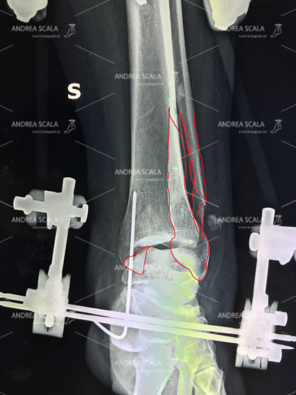 La frattura del perone e del malleolo tibiale è stata trattata con fissatore esterno. 