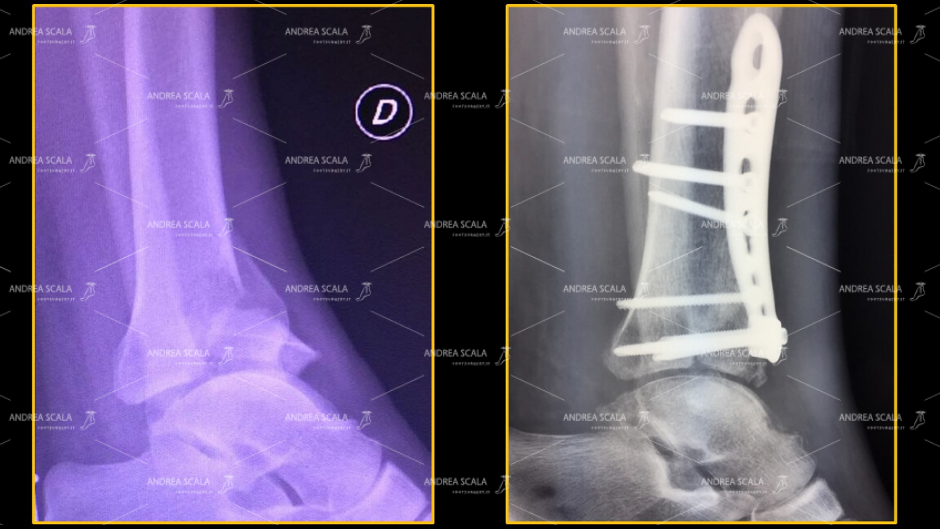 frattura della superficie articolare e della sovrastante metafisi distale di tibia fratture del “pilon tibial”.