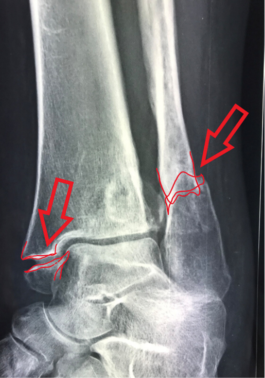 La Rxgrafia mostra che a distanza di mesi si vede la frattura non è guarita nella posizione corretta. La frattura è evoluta nella artrosi della caviglia.