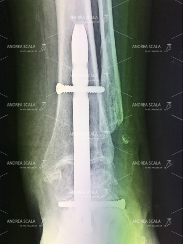 A causa del grave dolore e della difficoltà a camminare uno specialista ortopedico ha pensato di bloccare la caviglia. La RX anteriore mostra che l’articolazione viene bloccata con artrodesi. Il perone viene asportato e viene impiantato un chiodo con viti.