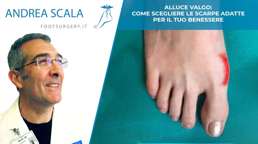 Alluce valgo: come scegliere le scarpe adatte per il tuo benessere