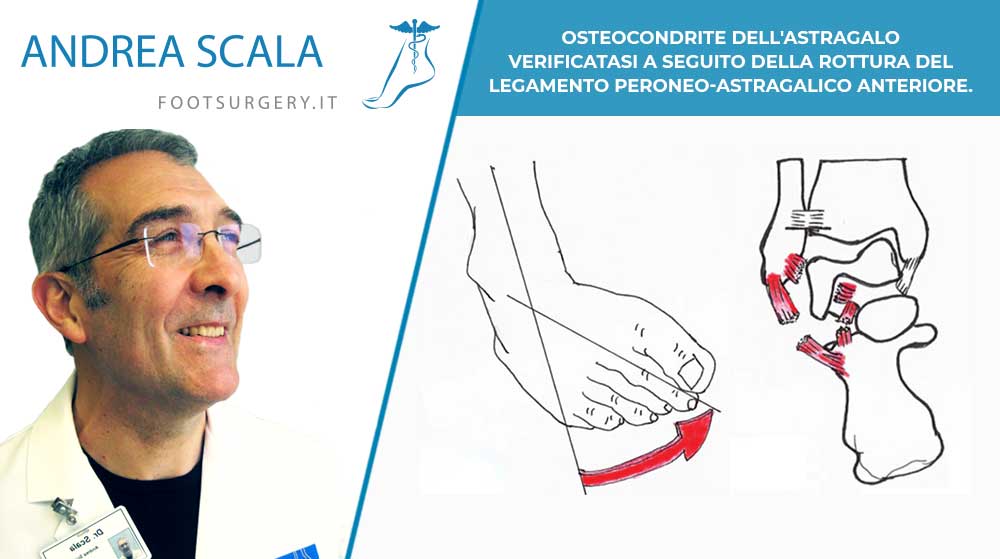 OSTEOCONDRITE DELL’ASTRAGALO verificatasi a seguito della rottura del LEGAMENTO PERONEO-ASTRAGALICO ANTERIORE.