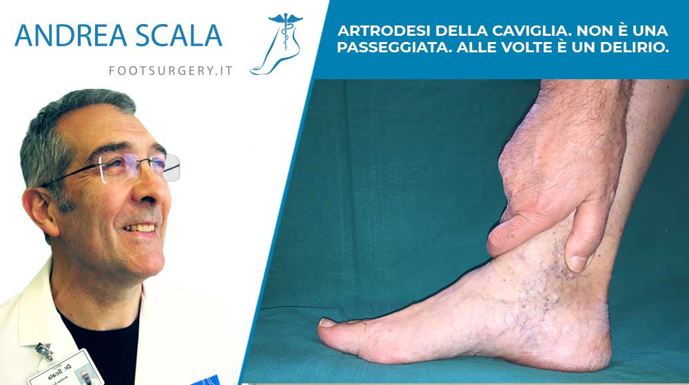 ARTRODESI DELLA CAVIGLIA. NON È UNA PASSEGGIATA. ALLE VOLTE È UN DELIRIO