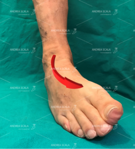 Legamenti della caviglia rotti: dopo l'operazione si torna a camminare