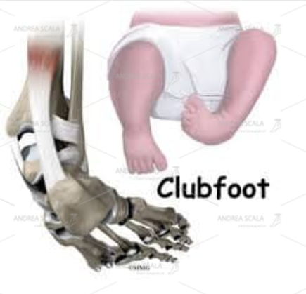 Lo schema mostra l’aspetto clinico e la patologica anatomia del piede torto congenito.