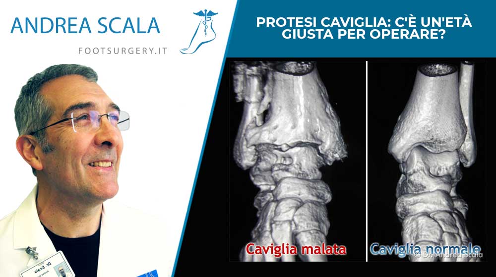 Protesi caviglia: c’è un’età giusta per operare?