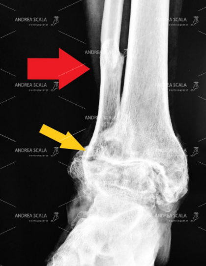 Operazione caviglia: tra tecniche innovative e protesi su misura