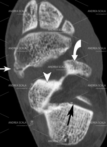 1 In questo esempio di immagine ben definita  la TAC eseguita con il taglio assiale mette in evidenza l’articolazione tra astragalo e calcagno. Si vede l’articolazione sottoastragalica indicata con una freccia nera. Si vede lo scafoide che si articola con le basi dei cuneiformi.
