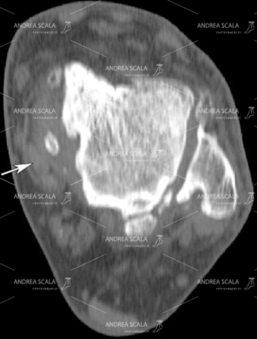 10 Anche questa proiezione assiale della caviglia mette in evidenza l’artrosi. E’ molto accurata, individua la malattia e  fa capire al chirurgo dove occorre intervenire. Il tutto per il bene del paziente.