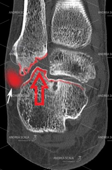 La TAC mostra che la frattura non operata  ha un frammento di osso spostato che causa un grave dolore in sede laterale al perone. I tendini peronieri soffrono per colpa della frattura.