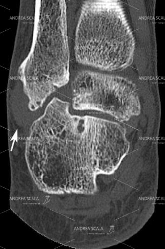 11 In questo taglio coronale molto ben eseguito si vedono gli esiti della frattura del calcagno. La parete laterale fratturata non è stata operata e ricomposta. L’osso del calcagno si è spostato ed è andato ad occupare lo spazio sotto il malleolo peroneale. In quella sede ci sono i tendini peronieri che non funzionano bene e soffrono  per colpa della frattura non ben curata.