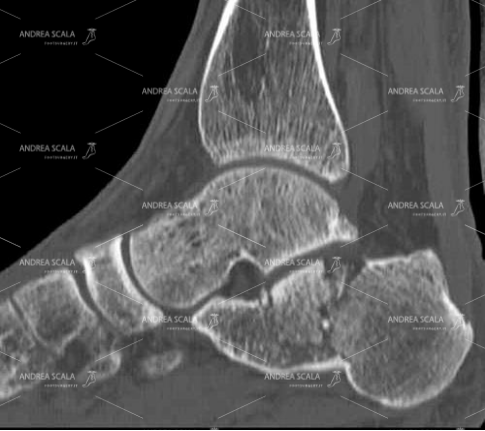 12 Questo taglio sagittale fa vedere la frattura del calcagno.  La frattura del calcagno è molto grave perché viene rovinata la sottoastragalica (vedi sopra). Come in questo caso in cui è stata eseguita una TAC e la frattura del calcagno è stata evidenziata. Molto spesso al Pronto Soccorso si fa solo una RXgrafia. Attenzione! nella RXgrafia normale la frattura non si vede. Ci vorrebbe un professionista ortopedico esperto e ci vorrebbe uno specialista radiologo esperto che esegue una TAC.