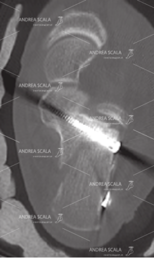 la TAC assiale mostra frattura messa a posto con l’operazione vera e propria e la stabilizzazione con placca e viti.