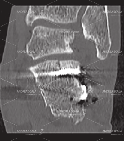La TAC coronale mostra frattura messa a posto con l’operazione vera e propria e la stabilizzazione con placca e viti.