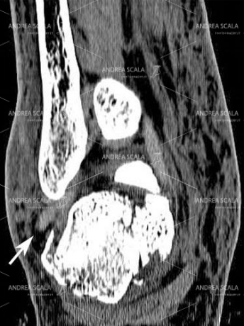13 Questo taglio TAC coronale mette in evidenza la frattura del calcagno a carico della superficie articolare del calcagno. Se non si fa la TAC non si capisce la gravità della frattura. Il paziente viene dimesso dicendogli che basta un gesso. Oppure si fa un intervento co fili di Kirschner. Si dice al paziente che va bene così. Ma non è così. Il paziente sta male e non può camminare.