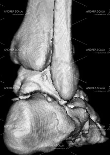 14 Questa TAC ricostruzione 3D fa vedere la frattura della parete laterale del calcagno. Lo spazio tra il malleolo peroneale ed il calcagno si è ridotto. Sicuramente si è verificata una sofferenza dei tendini peronieri