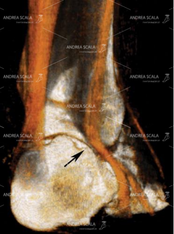 14 Questa TAC ricostruzione 3D fa vedere la frattura della parete laterale del calcagno. Lo spazio tra il malleolo peroneale ed il calcagno si è ridotto. Sicuramente si è verificata una sofferenza dei tendini peronieri