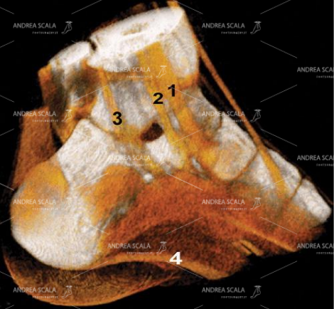 17 Un’ esame TAC avanzato fa vedere il decorso dei tendini del compartimento mediale.