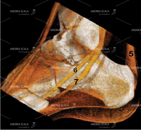 18 Un’ esame TAC avanzato fa vedere il decorso dei tendini del compartimento laterale.