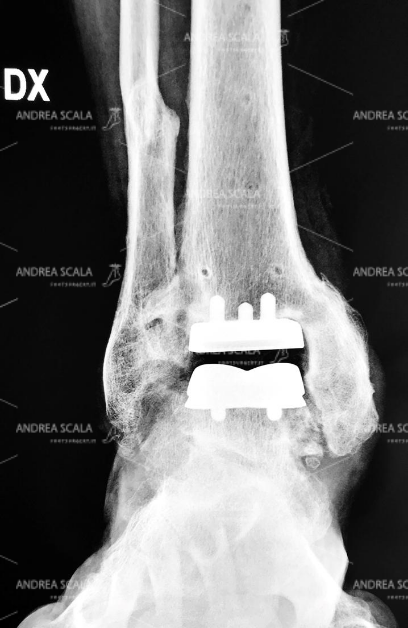 La RXgrafia della protesi della caviglia impiantata per la via anteriore mostra le componenti ben allineate. L’artrosi è stata rimossa e l’articolazione è nuovamente visibile. Vuol dire che la mobilità è presente. Il ponte osseo tra tibia e perone è stato lasciato al suo posto.