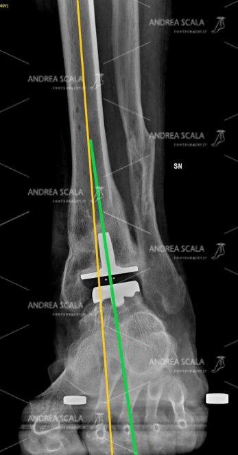 La RXgrafia eseguita nelle stesse condizioni mostra l’impianto della protesi di caviglia. In questo caso particolare è stata scelta una protesi con il fittone tibiale che è stato allineato secondo L’ASSE BIOMECCANICO allo scopo di assicurare alla protesi un funzionamento migliore e una vita più lunga.