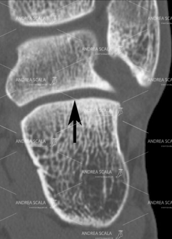 2 In questa proiezione TAC con taglio coronale si vede l’articolazione tra  astragalo e calcagno indicata con una freccia nera. In teoria i tagli devono esse acquisiti direttamente e non ricostruiti.