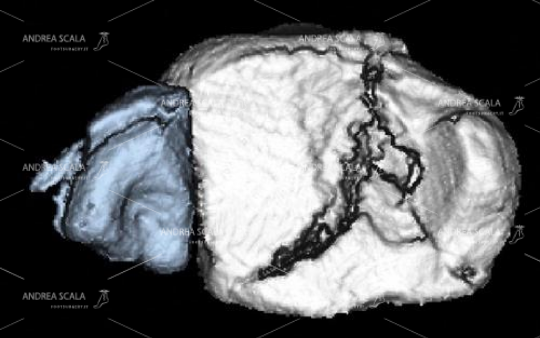 20 L’esame TAC con taglio assiale più specifico mette in evidenza una frattura del pilone ( e del plafond tibiale) non evidente nella RXgrafia normale.