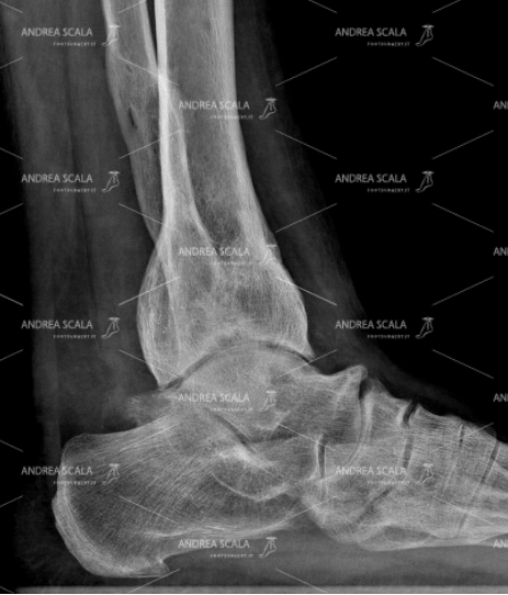 La RXgrafia laterale mostra la grave artrosi della caviglia. L’articolazione è quasi scopmparsa e le ossa si toccano impedendo il normale movimento. L’artrodesi è assolutamente controindicata in questo caso dal memento che le ossa tarsali sono già compromesse dalla artropatia. La artrodesi avrebbe comportato un piede dolorosissimo per tutta la vita.