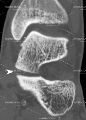 3 Questo taglio coronale mette in evidenza sia la tibio tarsica che la sottoastragalica a livello del “seno del tarso”.