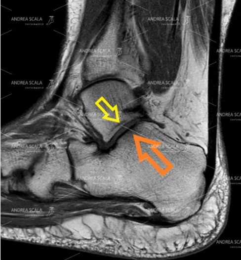 Le frecce indicano la visione sagittale dell’articolazione tra calcagno e astragalo. Quando il calcagno è fratturato si deve operare.