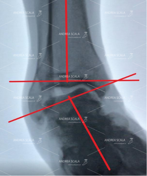 La RXgrafia mostra la caviglia di uno sportivo sotto stress. Quando avviene il movimento della distorsione il piede non è trattenuto dai legamenti. L’asse della tibia non è più in asse con il piede. L’astragalo ed il calcagno sono completamente spostati all’interno