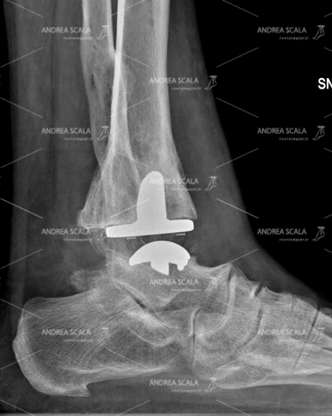 La RXgrafia laterale dopo l’impianto della protesi mostra che l’articolazione della caviglia è stata ricostruita. E’presente lo spazio articolare. In questo caso particolare è stata scelta una protesi con il fittone tibiale.