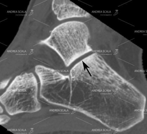 4 Questo è un esempio di taglio sagittale che mette in evidenza sia la tibio tarsica che la sottoastragalica, che viene indicata con una freccia nera.