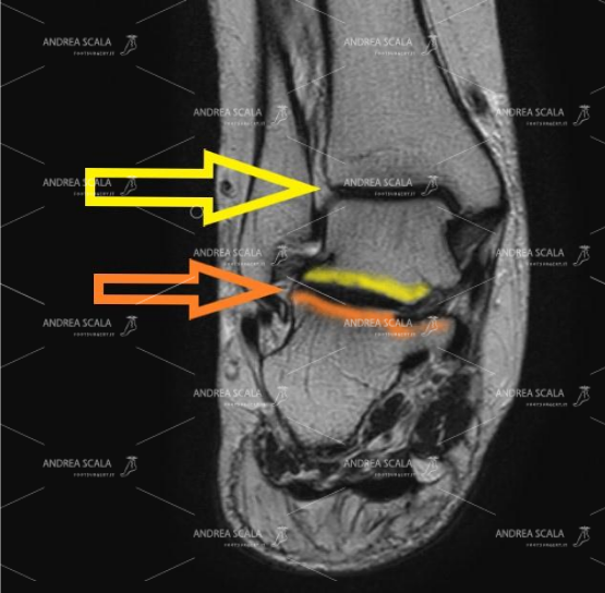 Le frecce indicano la visione sagittale dell’articolazione tra calcagno e astragalo. Quando il calcagno è fratturato si deve operare.