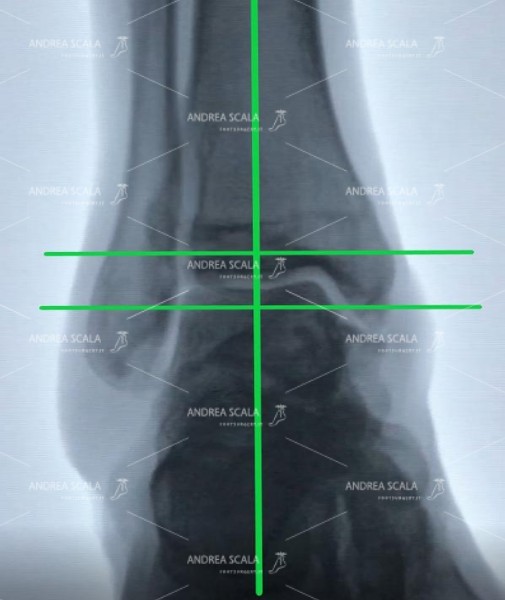 La RXgrafia mostra la caviglia di uno sportivo in fase di riposo. La caviglia è normale con la tibia in asse con il piede.