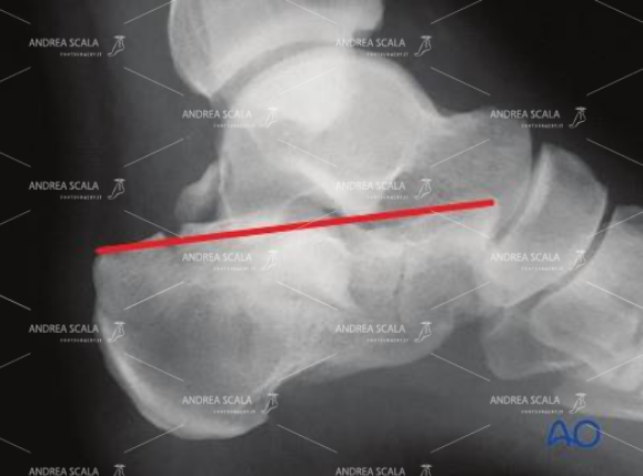 La linea rossa fa vedere lo schiacciamento del calcagno, ma spesso nessuno se ne accorge in pronto Soccorso.