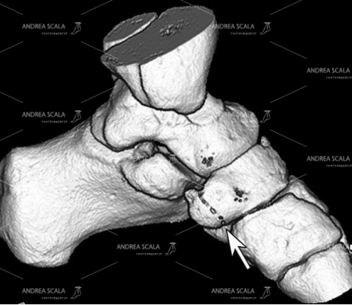 5 Questa ricostruzione 3D del versante mediale dell’arco del piede è molto ben eseguita e molto ben dettagliata. Le ricostruzioni 3D devono essere almeno 6 per ogni piede.