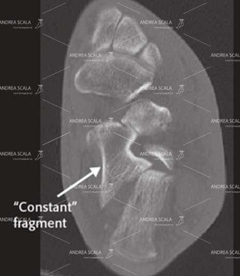Si vede  il taglio TAC assiale del calcagno fratturato.