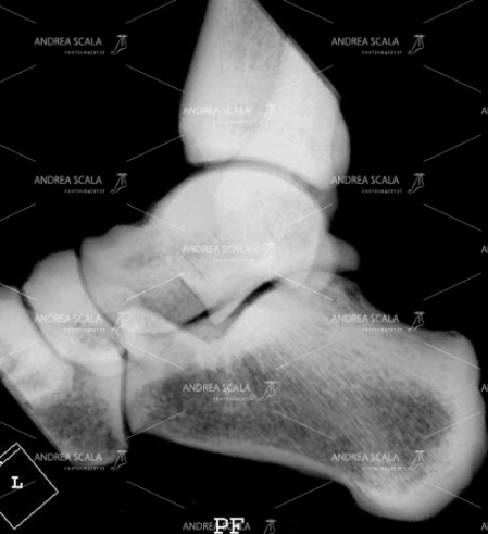 7 Anche questa ricostruzione 3D del versante laterale del piede è scadente e  non mette in evidenza i particolari.